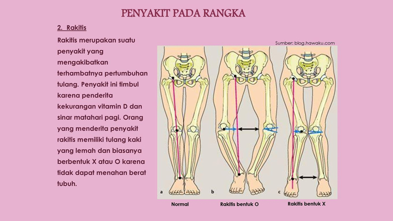 Orang yang memiliki tulang kaki yang lemah dan biasanya berbentuk x atau o menderita penyakit